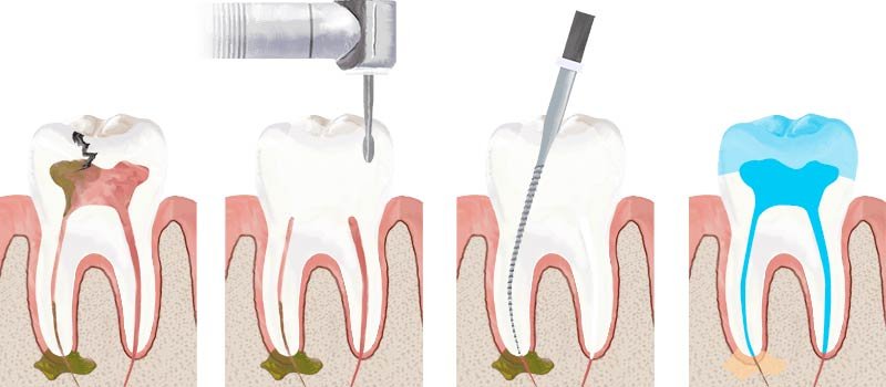 Root Canal Tooth Procedure