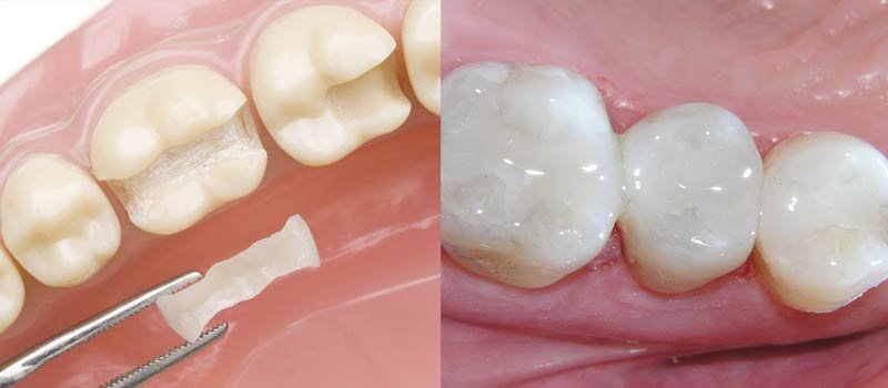 tooth-filling-800x350